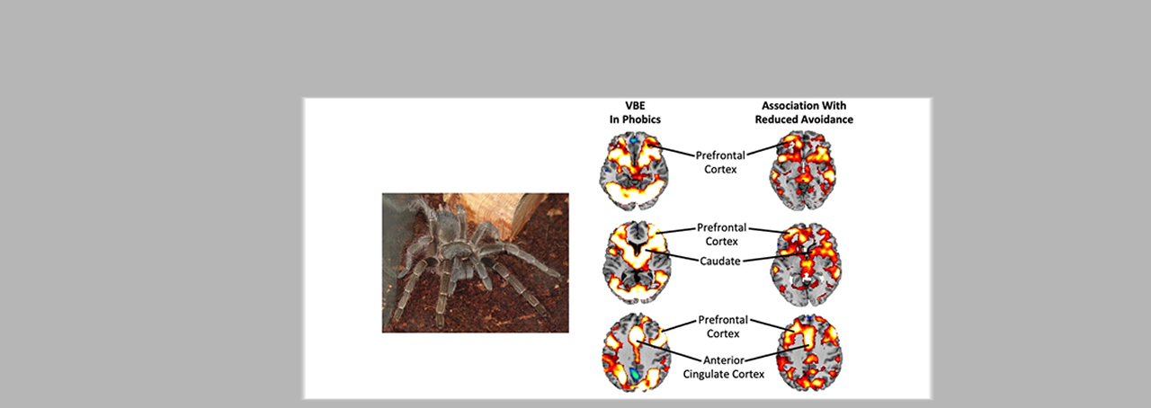 functional magnetic resonance image from double-blind placebo controlled experiment focused on arachnophobia by Dr. Paul Siegel from Purchase College published in The Lancet Psychiatry